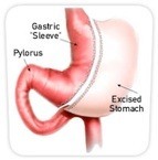 Gastric Sleeve / Sleeve Gasterectomy